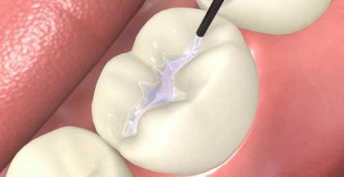 dental sealants in Beamsville